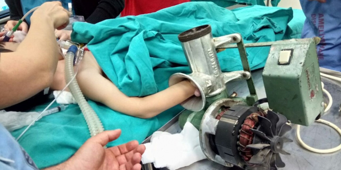 Beş yaşındaki çocuk kıyma makinesiyle hastaneye kaldırıldı