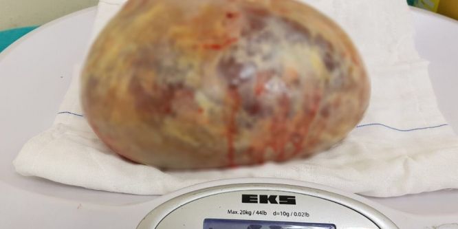 Hastadan 5 kilo 350 gram kist çıkarıldı