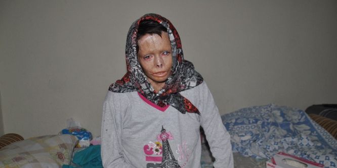 Esad’ın yaktığı Suriyeli Nuha Türkiye’de şifa buluyor