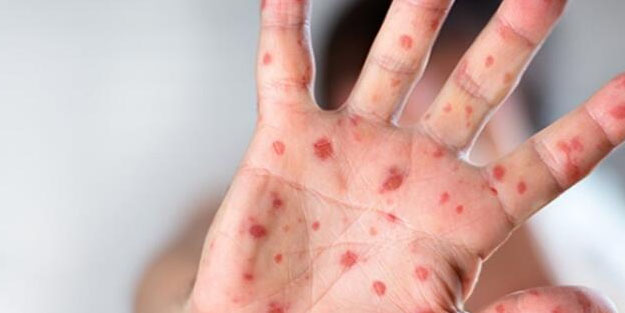 ABD sağlık uzmanları uyardı: Maymun çiçeği hastalığının tespiti zorlaştı