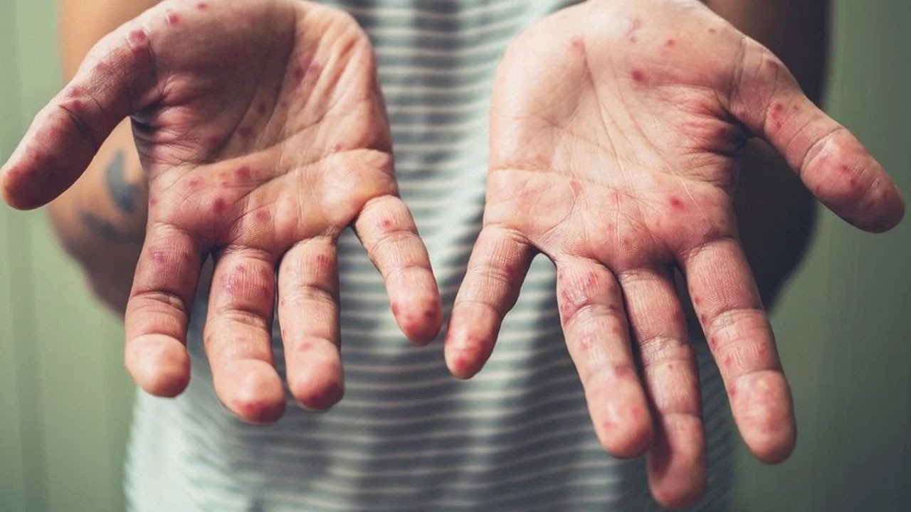 ABD’de kızamık alarmı! 12 eyalete yayıldı can kaybı var