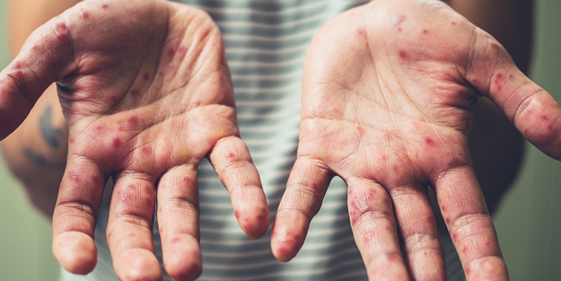 ABD'de kızamık alarmı! 20 bin kişinin...