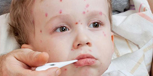 ABD'de kızamık vakaları 25 yılın en yüksek seviyesine çıktı