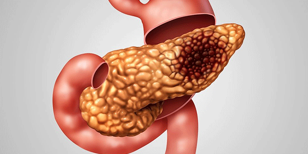 ABD'li doktorlar doktorlar uyardı! İşte pankreas kanseri olmamak için uzak durmamız gerekenler
