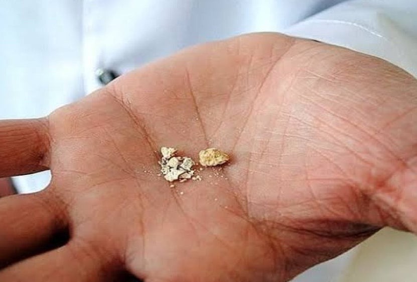 Aç karnına bir bardak içen böbrek taşlarını patır patır döküyor! Hem karaciğeri, hem dalağı tertemiz yapıyor! Faydaları saymakla bitmez