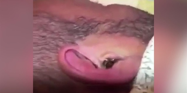 Adamın kulağından çıkan canlıya inanamayacaksınız!