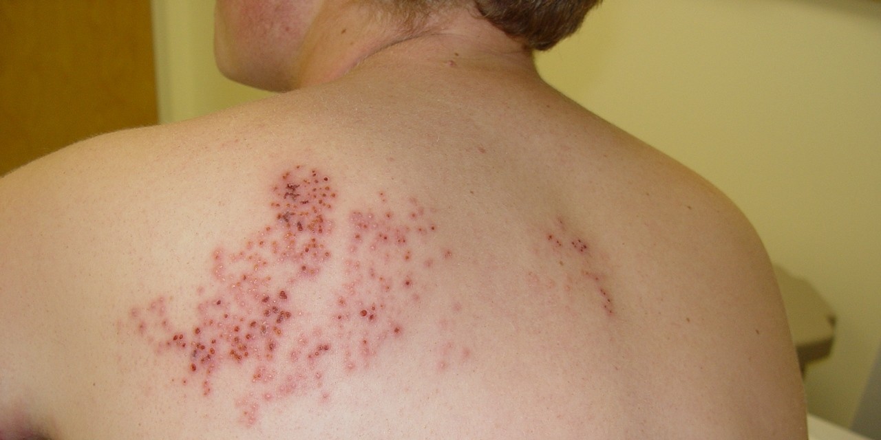 Açık tenliler dikkat! Her 10 kişiden 3'ü risk altında