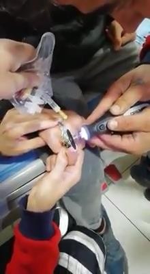 Acil serviste yüzük operasyonu nefes kesti 