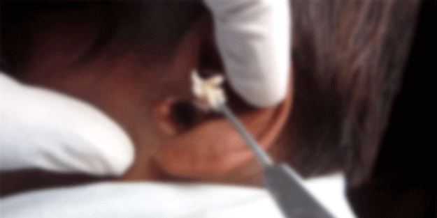 Adana’da çocuğun kulağından öyle şeyler çıktı ki, doktorlar bile şok oldu!