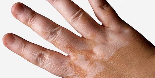 Addison hastalığı nasıl tedavi edilir?