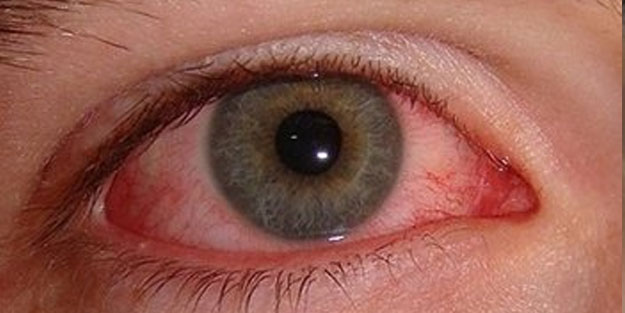 Adenovirüs gözlerimizi tehdit ediyor