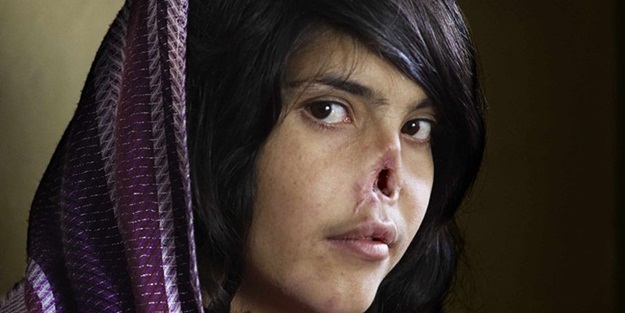 Afgan kız yeni burnuna kavuştu - FOTO