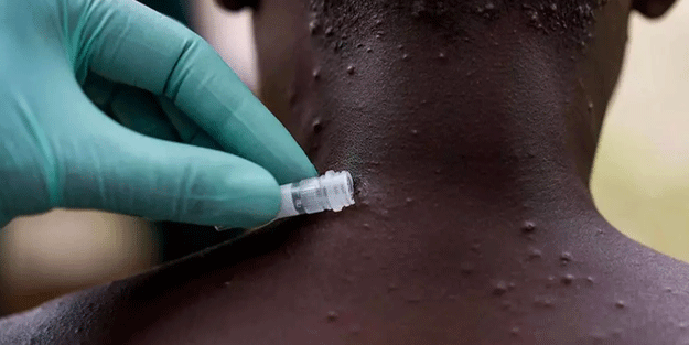 M çiçeği alarmı verildi