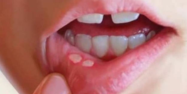 Aft çıkarsa yapmanız gerekenler