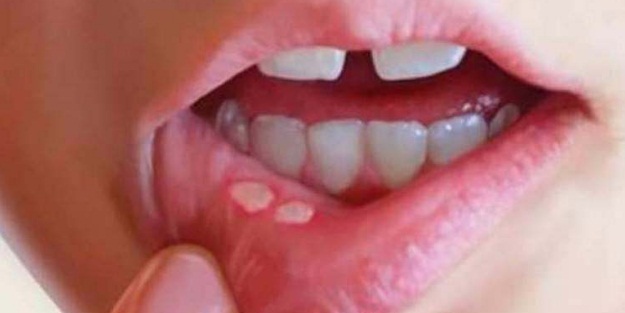 Aft çıkarsa bunu yapın!