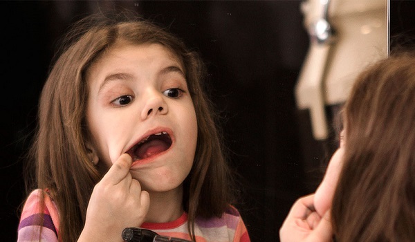 Aft nedir? Afttan doğal yöntemlerle kurtulmak mümkün mü?