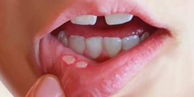 Afta (Ağız yarası) neden olan etmenler nelerdir?