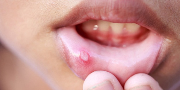 Ağız içinde çıkan yaralara dikkat!