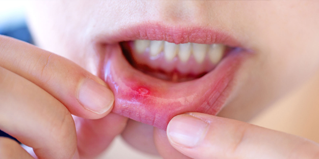 Ağız kanserinin bu belirtisine dikkat!
