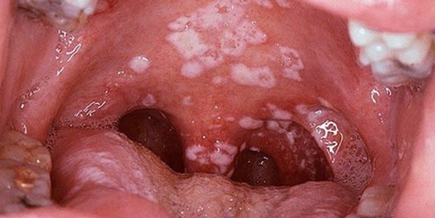 Ağız mantarı neden olur?