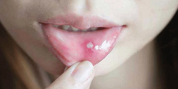 Ağız yaralarını hafifletmek için 5 doğal çözüm
