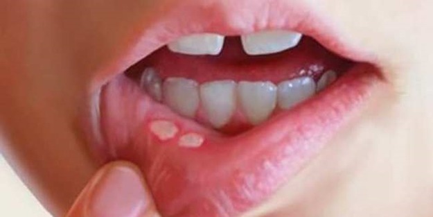 Ağız yarası oluşumunun başlıca sebepleri nelerdir?