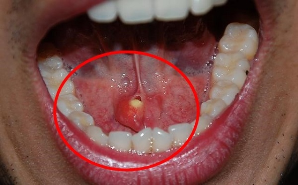 Ağızda gizlenen sinsi tehlike