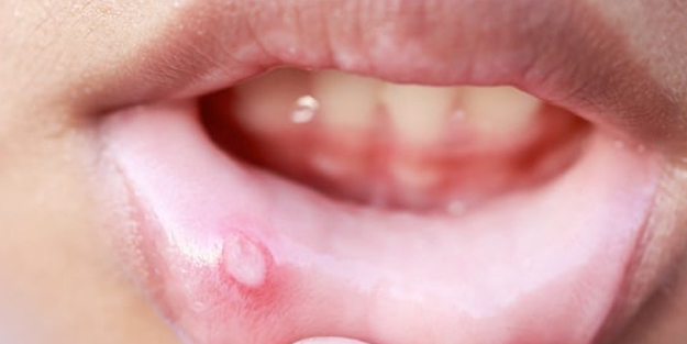 Ağızdaki yaraları 1 saat içinde yok ediyor! Gerçekten şifa karışım: Faydaları hemen tesir etti! İlk defa duyacaksınız