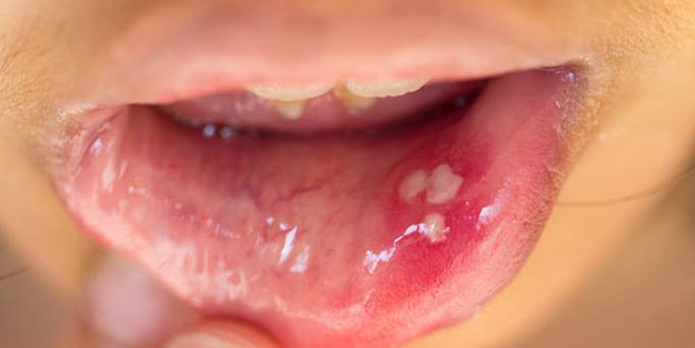 Ağızdaki yaralardan kurtulmak için bu yöntemi deneyin