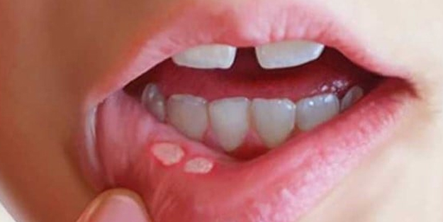 Ağızdaki yaraları 1 saat içinde yok ediyor! Her yerde aranan gizemli hazine gibi o tarif! Hemen yapın