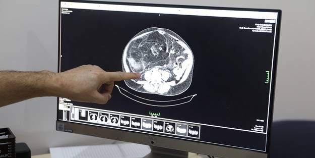 Ağrıyla hastaneye gitti, karnından çıktı: 35 kilo