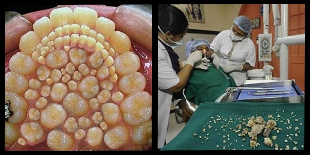 Ağzından tam 232 diş çıkarıldı