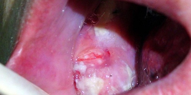 Ağzınızda bu belirtiler varsa dikkat!