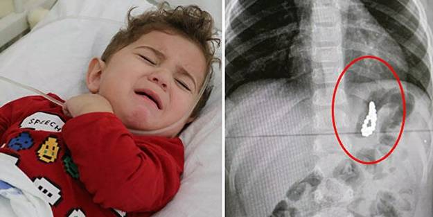 Aileler dikkat! 19 aylık bebeğin midesinden çıktı