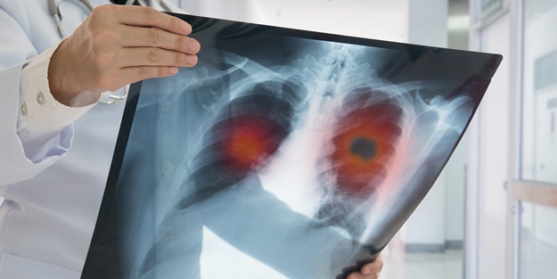 Akciğer hastalıkları akciğer kanseri riskini artırıyor