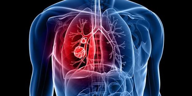 Akciğer iltihabı belirtileri nelerdir?