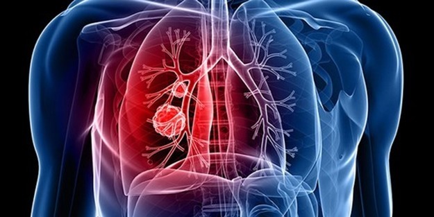 Akciğer kanseri nasıl teşhis edilir?