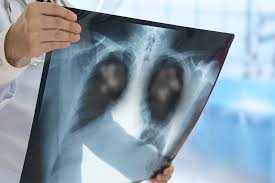 Akciğer kanserine yakalanma riski bu kişilerde 25 kat fazla...