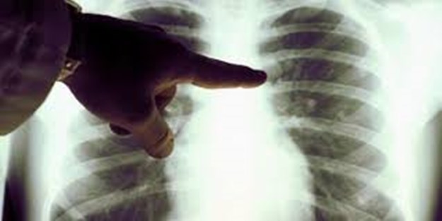 Akciğer kanserinin 7 belirtisi