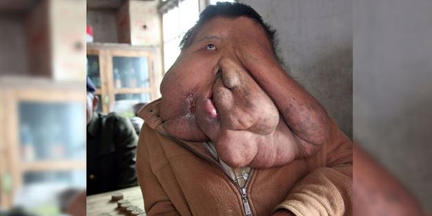 Akılalmaz hastalıkla 35 yıldır mücadele ediyor