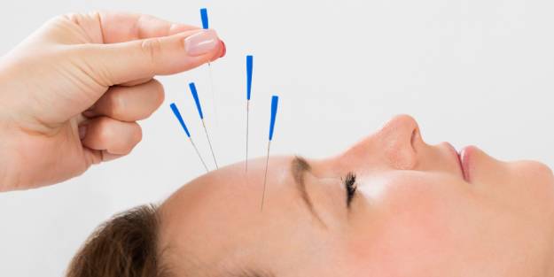 Akupunktur gerçek mi? Akupunktur (Ynsa) nedir, nasıl yapılır?