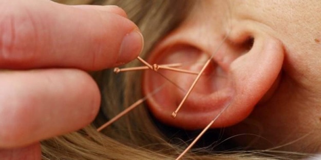 Akupunktur ile kilolardan kurtulmak mümkün