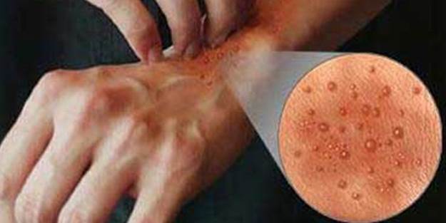 Alerjiden nasıl korunuruz, belirtileri nelerdir?