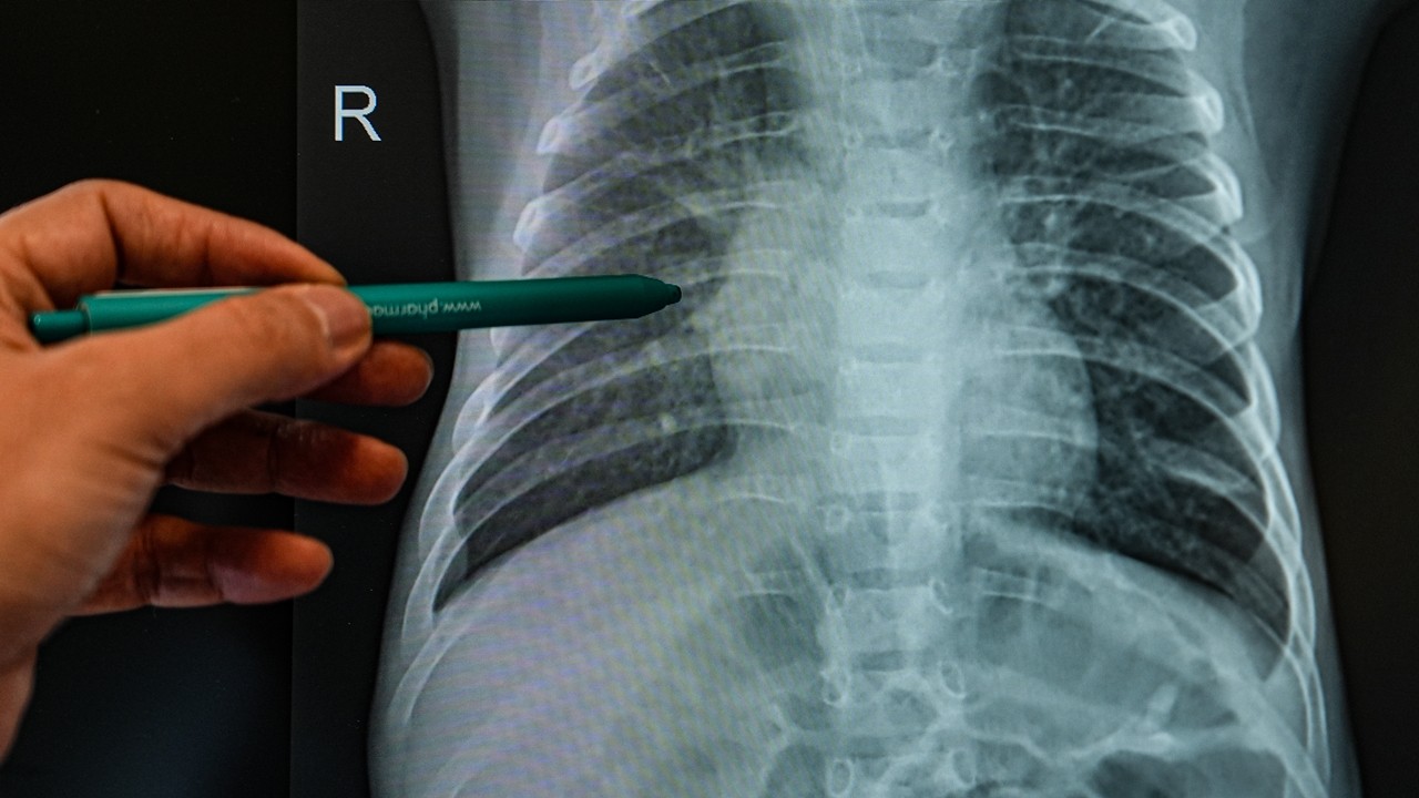 Alerjik çocuklarda enfeksiyon riski daha yüksek!