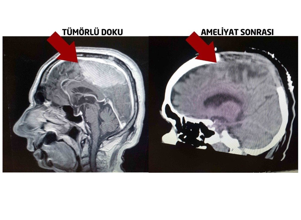 Alman doktorların felç ettiği hastayı Türk doktorlar ayağa kaldırdı 