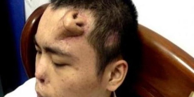 Alnında burun çıktı