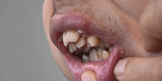 Alt çenesi yok, dişleri üst damağında: Ameliyat için yardım bekliyor