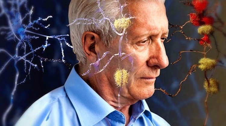 Alzheimer’a karşı yeni bir umut ışığı