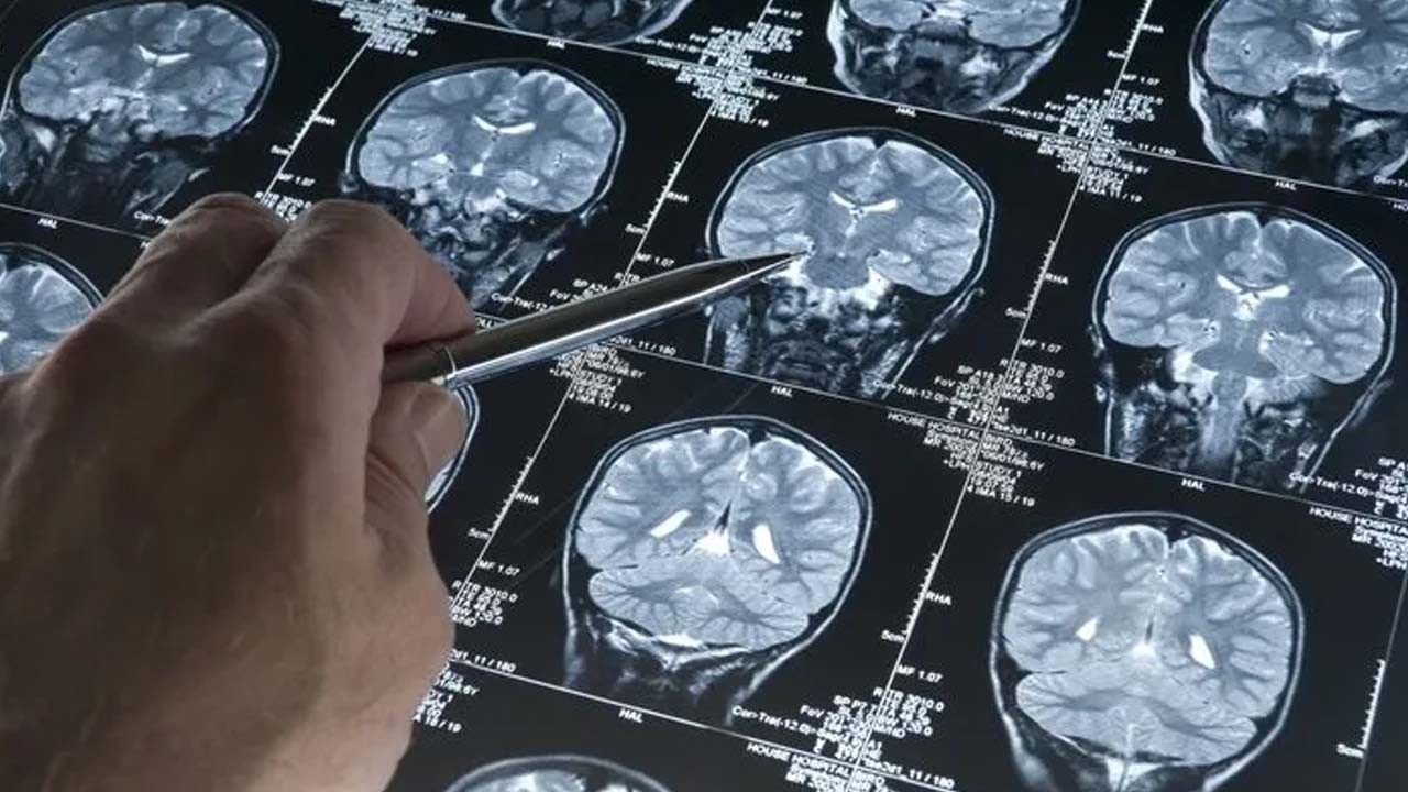 Alzheimer'ı 20 yıl önce haber veriyor: Bu sorunu yaşıyorsanız…