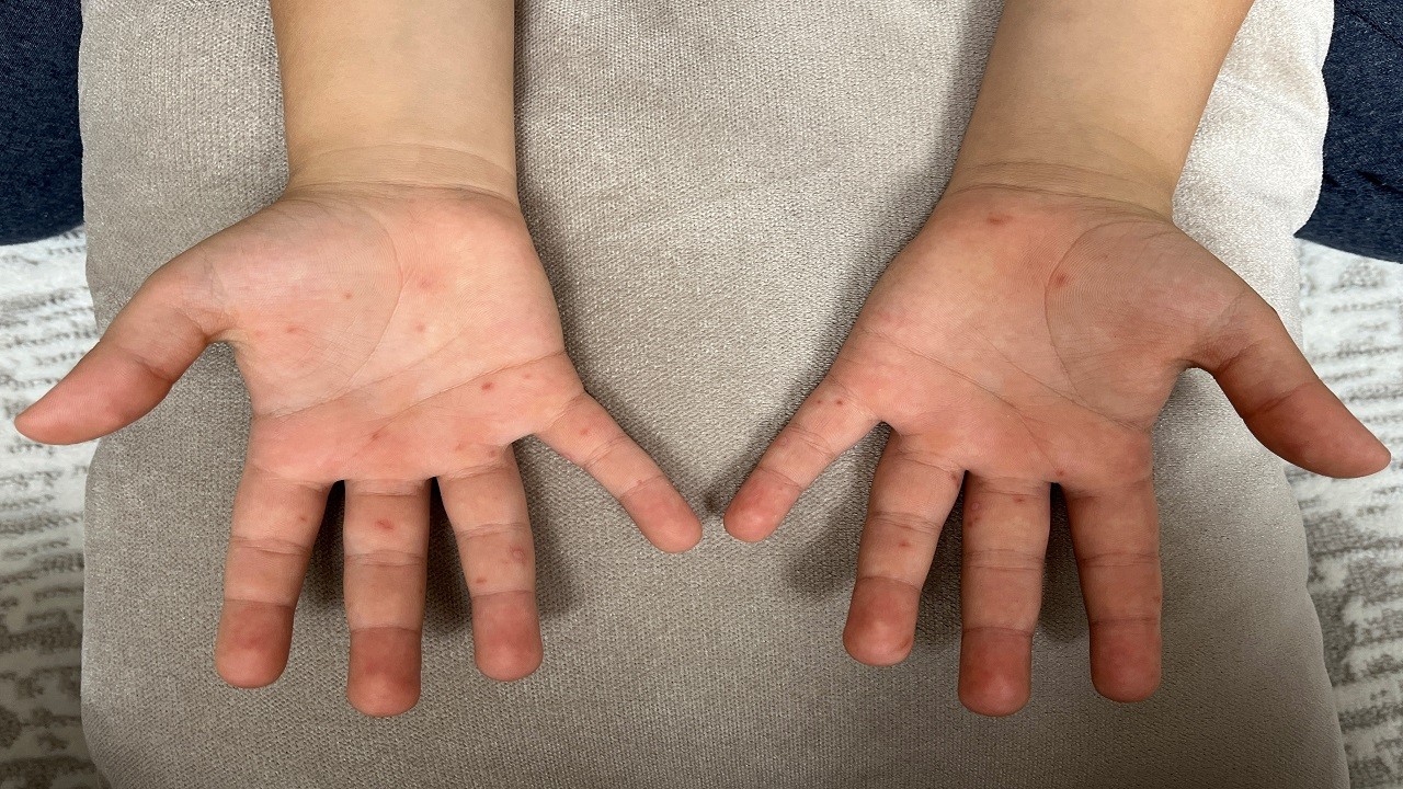 Aman dikkat! Bu hastalık çocukları tehdit ediyor